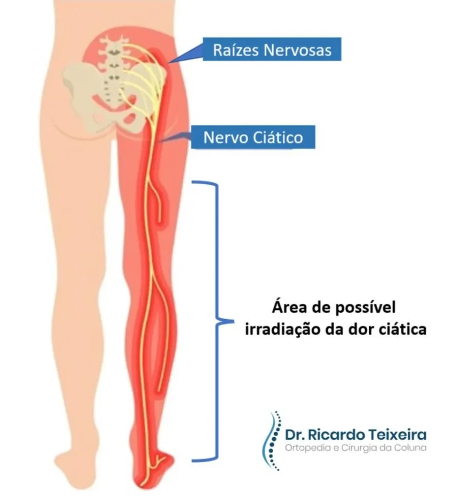 Dor no nervo ciático pode afetar até 40% da população: Como aliviar os sintomas?